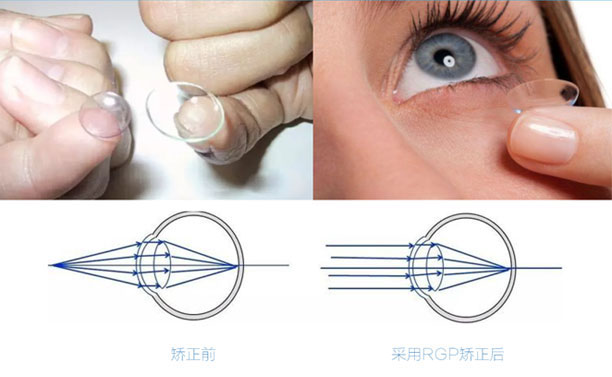 隐形眼镜配戴者最理想的选择