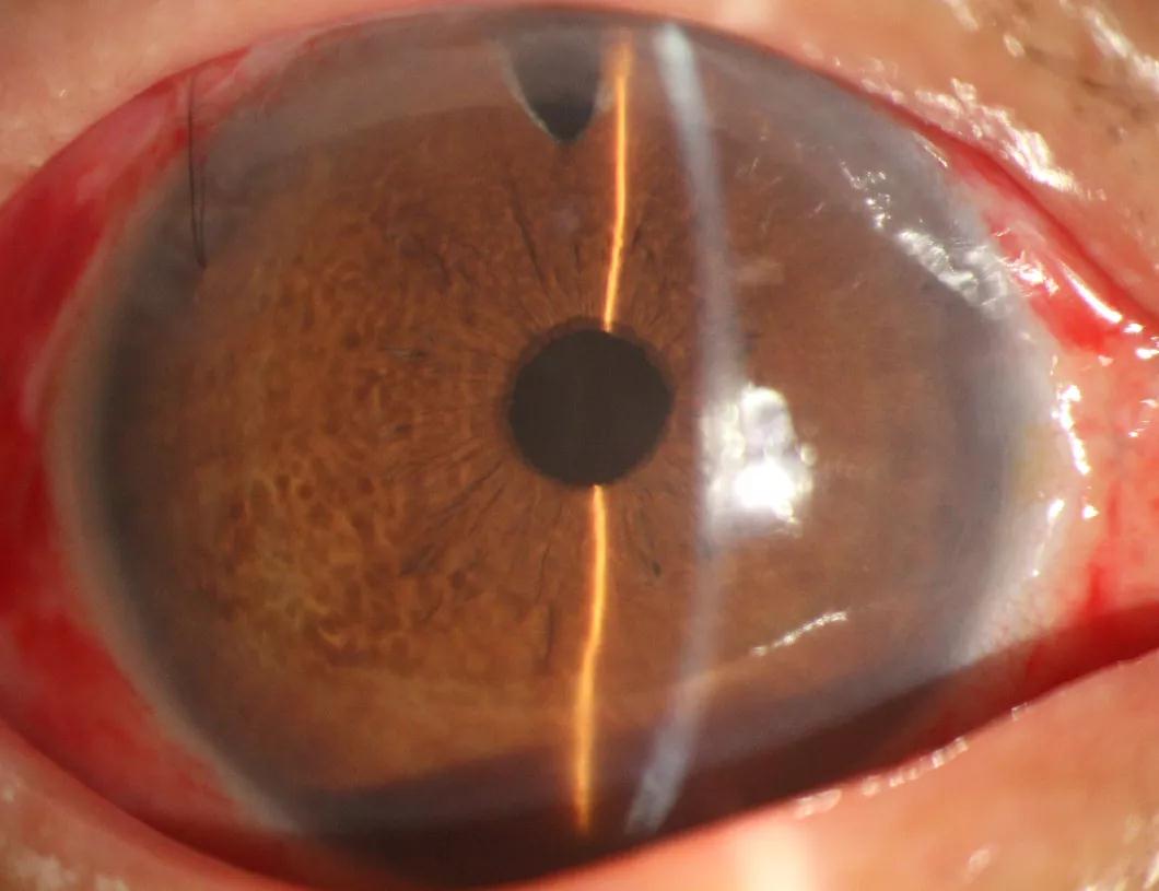 术后第一天,眼前节照相